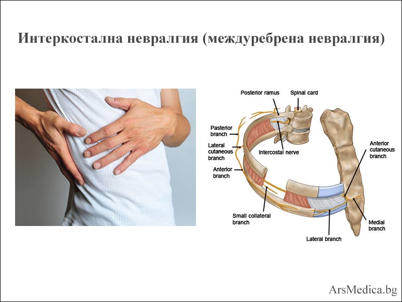 интеркостална невралгия